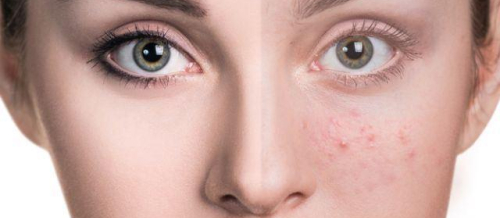 Dermatokosmetik prosedurlar, Dermatoloq, mezoterapiya, Üzdə səpgilər, Akne Dermatokosmetik prosedurlar, Dermatoloq, mezoterapiya, Üzdə səpgilər, Akne