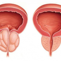 Cinsi xəstəliklərin əlamətləri, cinsi infeksiyalar, Cinsi xəstəliklərin müalicəsi, Cinsi zəiflik