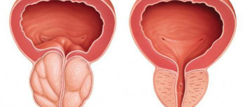 Cinsi xəstəliklərin əlamətləri, cinsi infeksiyalar, Cinsi xəstəliklərin müalicəsi, Cinsi zəiflik