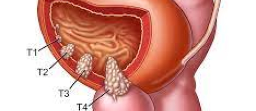 Cinsi xəstəliklərin əlamətləri, cinsi infeksiyalar, Cinsi xəstəliklərin müalicəsi, Cinsi zəiflik