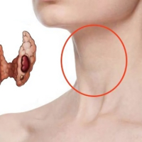 Endokrinoloji xəstəliklər, Zəhərli tənbəl və düyünlü zob xəstəlikləri, zob xəstəlikləri, Qraves xəstəliyi, Düyünlü zob xəstəlikləri