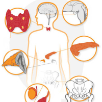 Endokrinologiya, Şəkərsiz diabet, endokrinoloji, Şəkərli Diabet, Endokrin sonsuzluq