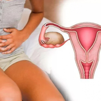 Yumurtalıqda Kistalar, Yumurtalıq kistaları nədir, Yumurtalıq kistlərinin növləri, Yumurtalıq Kistasının Müalicəsi Yumurtalıqda Kistalar, Yumurtalıq kistaları nədir, Yumurtalıq kistlərinin növləri, Yumurtalıq Kistasının Müalicəsi