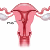 Ginekoloji infeksiyalar, Bakterial vaginoz, Mikoplazma və ureaplazma, Mikoplazma xəstəliyi, Herpes Ginekoloji infeksiyalar, Bakterial vaginoz, Mikoplazma və ureaplazma, Mikoplazma xəstəliyi, Herpes