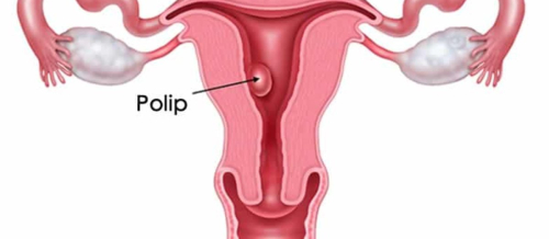 Ginekoloji infeksiyalar, Bakterial vaginoz, Mikoplazma və ureaplazma, Mikoplazma xəstəliyi, Herpes