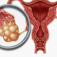 Menstruasiya pozulmaları, qanama və menstruasiya ağrıları, Anormal uşaqlıq qanaxması, Hipermenoreya Menstruasiya pozulmaları, qanama və menstruasiya ağrıları, Anormal uşaqlıq qanaxması, Hipermenoreya