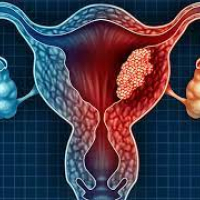 Menstruasiya pozulmaları, qanama və menstruasiya ağrıları, Anormal uşaqlıq qanaxması, Hipermenoreya Menstruasiya pozulmaları, qanama və menstruasiya ağrıları, Anormal uşaqlıq qanaxması, Hipermenoreya