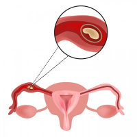 Menstruasiya pozulmaları, qanama və menstruasiya ağrıları, Anormal uşaqlıq qanaxması, Hipermenoreya Menstruasiya pozulmaları, qanama və menstruasiya ağrıları, Anormal uşaqlıq qanaxması, Hipermenoreya