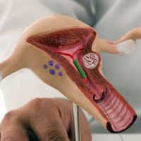 Sonsuzluq nədir, Qadın sonsuzluğu nədən yarana bilər, Anadangəlmə anomaliyalar, Sonsuzluğun diaqnostikası Sonsuzluq nədir, Qadın sonsuzluğu nədən yarana bilər, Anadangəlmə anomaliyalar, Sonsuzluğun diaqnostikası
