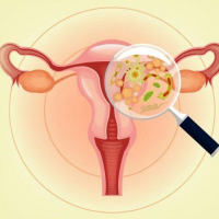 Uşaqlıq daxili spiral, Hormunlu spiralın faydaları, Hormonlu spiral, Hamiləlikdən qorunmaq Uşaqlıq daxili spiral, Hormunlu spiralın faydaları, Hormonlu spiral, Hamiləlikdən qorunmaq