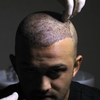 Sapphire saç transplantasiyası, FUE, Anesteziya metodu, DHI Birbaşa Saç İmplantı, Təraşsız Saç Transplantasiyası Sapphire saç transplantasiyası, FUE, Anesteziya metodu, DHI Birbaşa Saç İmplantı, Təraşsız Saç Transplantasiyası