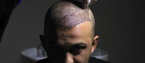 Sapphire saç transplantasiyası, FUE, Anesteziya metodu, DHI Birbaşa Saç İmplantı, Təraşsız Saç Transplantasiyası