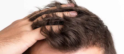 Saç əkimi nəticələri, Saç əkilməsi əməliyyatları, Saç Transplantasiyası, Saç əkilməsi sonrası, Saç Ekimi Qiymətləri, Saç Ekimi Bakı