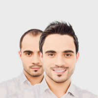 Saç əkimi nəticələri, Saç əkilməsi əməliyyatları, Saç Transplantasiyası, Saç əkilməsi sonrası, Saç Ekimi Qiymətləri, Saç Ekimi Bakı Saç əkimi nəticələri, Saç əkilməsi əməliyyatları, Saç Transplantasiyası, Saç əkilməsi sonrası, Saç Ekimi Qiymətləri, Saç Ekimi Bakı