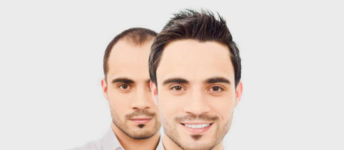 Saç əkimi nəticələri, Saç əkilməsi əməliyyatları, Saç Transplantasiyası, Saç əkilməsi sonrası, Saç Ekimi Qiymətləri, Saç Ekimi Bakı