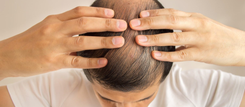 Saç Əkimi, Saç Nəqli Öncəsi, Azərbaycanda saç əkimi, Bakıda saç əkimi, Qaş Əkimi