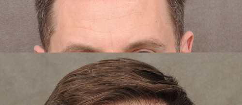 Saç köçürmələri, Saç tökülməsi problemi, saç transplantasiyası, Saçların nəqli, Saç Əkimi Qiymətləri