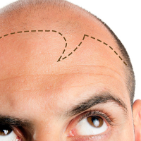 Sapphire saç transplantasiyası, FUE, Anesteziya metodu, DHI Birbaşa Saç İmplantı, Təraşsız Saç Transplantasiyası Sapphire saç transplantasiyası, FUE, Anesteziya metodu, DHI Birbaşa Saç İmplantı, Təraşsız Saç Transplantasiyası