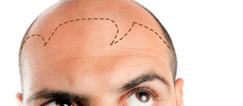 Sapphire saç transplantasiyası, FUE, Anesteziya metodu, DHI Birbaşa Saç İmplantı, Təraşsız Saç Transplantasiyası