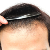 Kişi saç əkimi, Saç transplantasiyasına hazırlıq, kişi saç əkilməsi prosesi, Saç əkilməsinin nəticəsi Kişi saç əkimi, Saç transplantasiyasına hazırlıq, kişi saç əkilməsi prosesi, Saç əkilməsinin nəticəsi