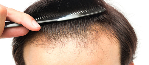 Kişi saç əkimi, Saç transplantasiyasına hazırlıq, kişi saç əkilməsi prosesi, Saç əkilməsinin nəticəsi