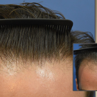Saç transplantasiyası, Saç transplantasiyası ilə tökülən saçların bərpası, Hansı köçürmə üsulunu seçmək, Transplantasiya qiyməti Saç transplantasiyası, Saç transplantasiyası ilə tökülən saçların bərpası, Hansı köçürmə üsulunu seçmək, Transplantasiya qiyməti