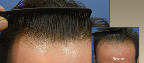 Saç transplantasiyası, Saç transplantasiyası ilə tökülən saçların bərpası, Hansı köçürmə üsulunu seçmək, Transplantasiya qiyməti