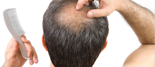 Saç transplantasiyası, Saç transplantasiyası ilə tökülən saçların bərpası, Hansı köçürmə üsulunu seçmək, Transplantasiya qiyməti