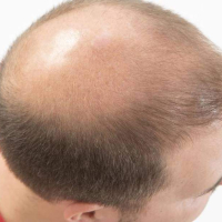 Sapphire saç transplantasiyası, FUE, Anesteziya metodu, DHI Birbaşa Saç İmplantı, Təraşsız Saç Transplantasiyası Sapphire saç transplantasiyası, FUE, Anesteziya metodu, DHI Birbaşa Saç İmplantı, Təraşsız Saç Transplantasiyası