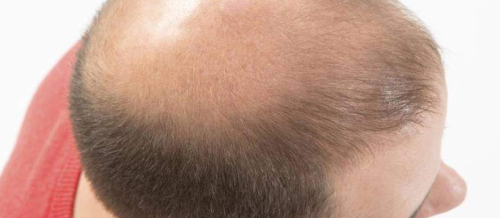 Sapphire saç transplantasiyası, FUE, Anesteziya metodu, DHI Birbaşa Saç İmplantı, Təraşsız Saç Transplantasiyası