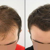 Saç əkimi kimlərə tətbiq oluna bilər, Əkim prosesi nə qədər çəkir, Prosedur ağrılıdır, əkilən saçlar tökülürmü Saç əkimi kimlərə tətbiq oluna bilər, Əkim prosesi nə qədər çəkir, Prosedur ağrılıdır, əkilən saçlar tökülürmü