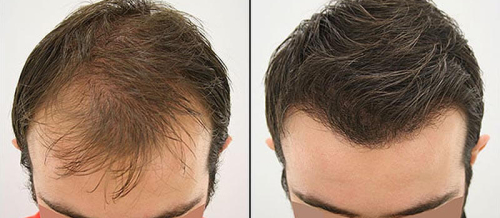 Saç əkimi kimlərə tətbiq oluna bilər, Əkim prosesi nə qədər çəkir, Prosedur ağrılıdır, əkilən saçlar tökülürmü