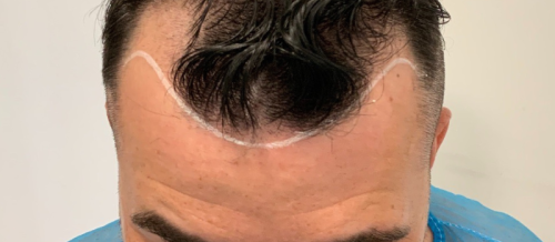 Saç əkimi kimlərə tətbiq oluna bilər, Əkim prosesi nə qədər çəkir, Prosedur ağrılıdır, əkilən saçlar tökülürmü