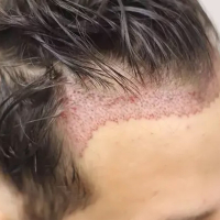 Saç əkimi kimlərə tətbiq oluna bilər, Əkim prosesi nə qədər çəkir, Prosedur ağrılıdır, əkilən saçlar tökülürmü Saç əkimi kimlərə tətbiq oluna bilər, Əkim prosesi nə qədər çəkir, Prosedur ağrılıdır, əkilən saçlar tökülürmü