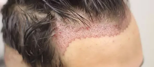 Saç əkimi kimlərə tətbiq oluna bilər, Əkim prosesi nə qədər çəkir, Prosedur ağrılıdır, əkilən saçlar tökülürmü