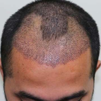 Saç əkimi necə icra olunur, Saç əkilməsi üçün donor tüklər, Saç əkimi prosesi, Azərbaycada saç əkimi Saç əkimi necə icra olunur, Saç əkilməsi üçün donor tüklər, Saç əkimi prosesi, Azərbaycada saç əkimi