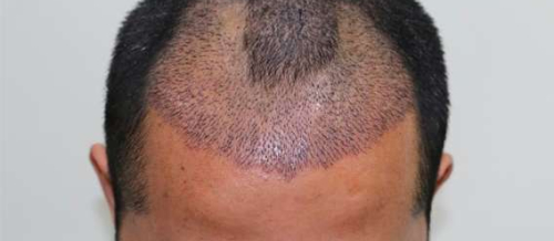 Saç əkimi necə icra olunur, Saç əkilməsi üçün donor tüklər, Saç əkimi prosesi, Azərbaycada saç əkimi