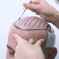 Saç tökülməsi, Saçların tökülməsi problemi, həkim-trixoloq, Müasir saç transplantasiyası, Saç köçürülməsi Saç tökülməsi, Saçların tökülməsi problemi, həkim-trixoloq, Müasir saç transplantasiyası, Saç köçürülməsi