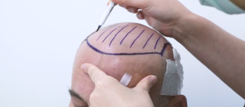 Saç tökülməsi, Saçların tökülməsi problemi, həkim-trixoloq, Müasir saç transplantasiyası, Saç köçürülməsi