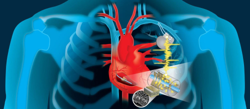 Aritmiyalar və ya ürəyin ritm pozuntusu, artan ürək döyüntüsü, Aritmiyaların tipləri, kadioloq Aritmiyalar və ya ürəyin ritm pozuntusu, artan ürək döyüntüsü, Aritmiyaların tipləri, kadioloq