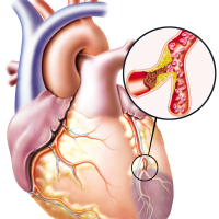 Ürək xəstəliklərinin əlamətləri, Ürək damar xəstəlikləri, Hipertoniya, İnfarktın əsas əlaməti Ürək xəstəliklərinin əlamətləri, Ürək damar xəstəlikləri, Hipertoniya, İnfarktın əsas əlaməti