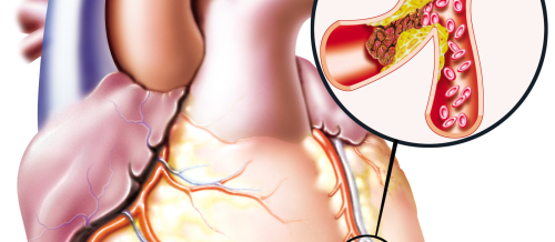 Ürək xəstəliklərinin əlamətləri, Ürək damar xəstəlikləri, Hipertoniya, İnfarktın əsas əlaməti Ürək xəstəliklərinin əlamətləri, Ürək damar xəstəlikləri, Hipertoniya, İnfarktın əsas əlaməti