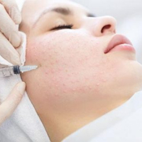 Kosmetologiya nədir,  Kosmetoloji fəaliyyət, Kosmetoloji, karbon pilinqi,  kimyəvi pilinq, Q-switched