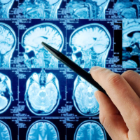 Nevrologiya, Nevroloji xəstəliklər, Baş ağrısı, demensiya, Yuxu pozğunluqları, əzələ xəstəlikləri, nevroloji müayinə