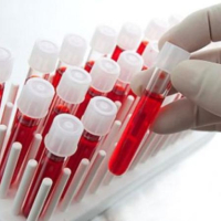 Parazit qurdlara yoluxma, Qurd xəstəlikləri, parazit növləri, Qurd xəstəliklərinin əlamətləri, Qurd xəstəliklərinin fəsadları