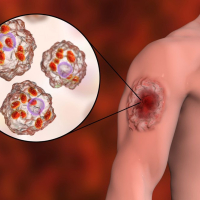 Qurd xəstəliklərinin orqanizmdə yaratdığı fəsadlar, İnsan orqanizmi qurda necə yoluxur, Yoluxucu xəstəliklər