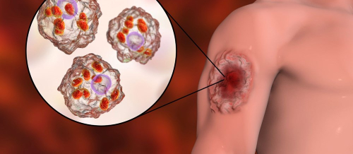 Qurd xəstəliklərinin orqanizmdə yaratdığı fəsadlar, İnsan orqanizmi qurda necə yoluxur, Yoluxucu xəstəliklər