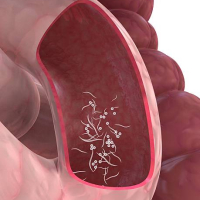 Qorxulu qurd xəstəliyi, Bağirsaq infeksiyalari, Bağırsaq infeksiyası nədir, Bağırsaq infeksiyalarının növləri
