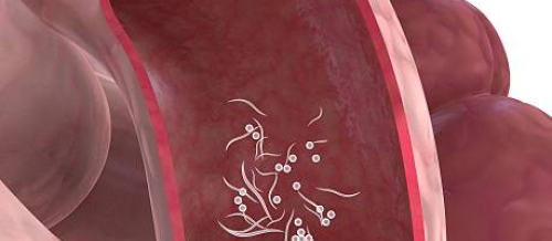 Qorxulu qurd xəstəliyi, Bağirsaq infeksiyalari, Bağırsaq infeksiyası nədir, Bağırsaq infeksiyalarının növləri