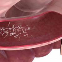 Qorxulu qurd xəstəliyi, Bağirsaq infeksiyalari, Bağırsaq infeksiyası nədir, Bağırsaq infeksiyalarının növləri